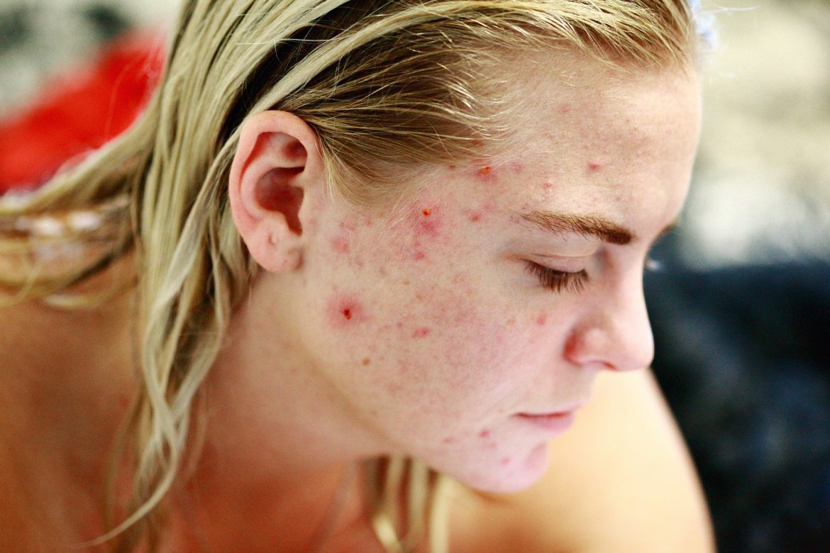 Qu’est-ce que l’acné . Pourquoi mon visage fait-il des éruptions ?